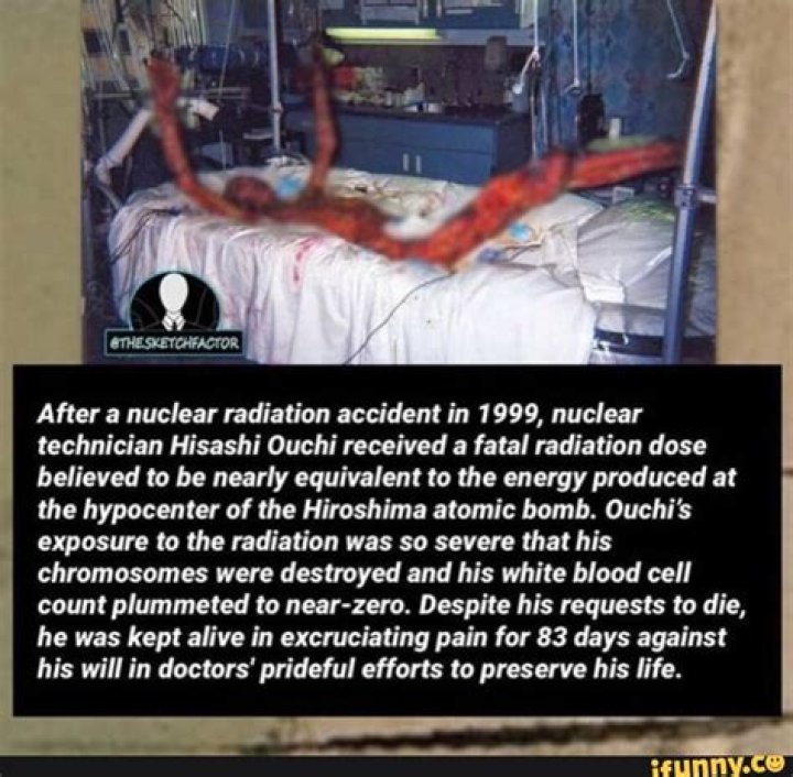The Actual Photos Of Hisashi Ouchi: A Tragic Reminder Of The Dangers Of Radiation